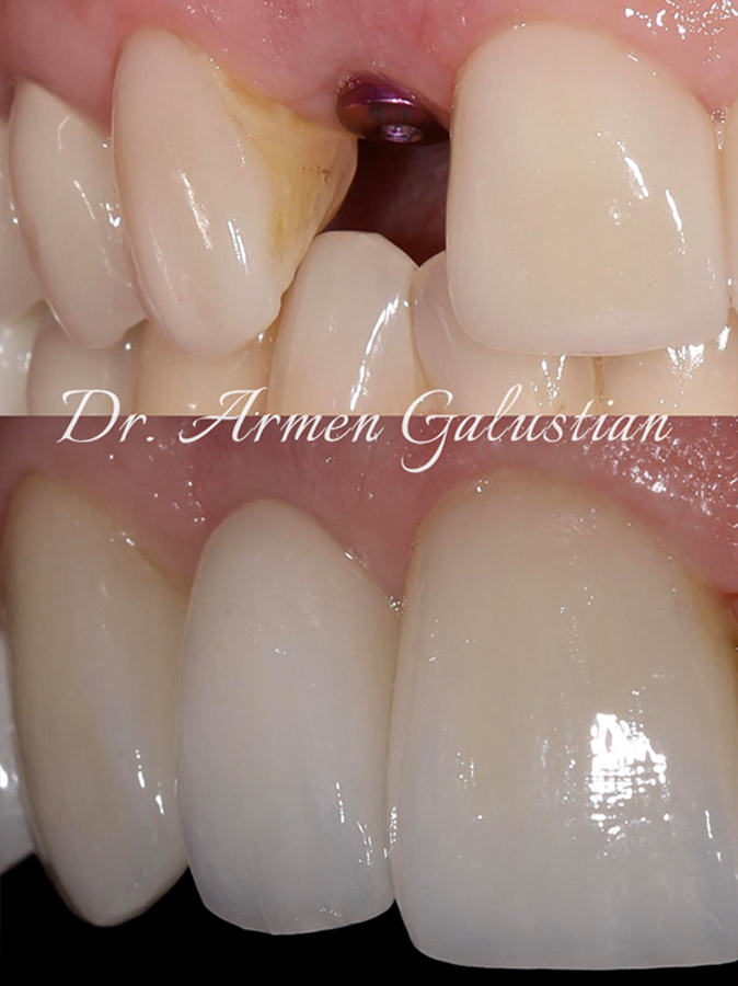 dental bridges cost